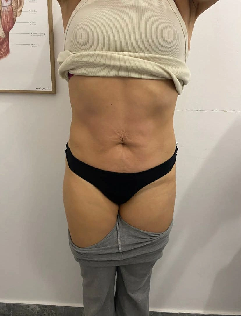 Magnifico II Premium modelowanie talii - po zabiegu