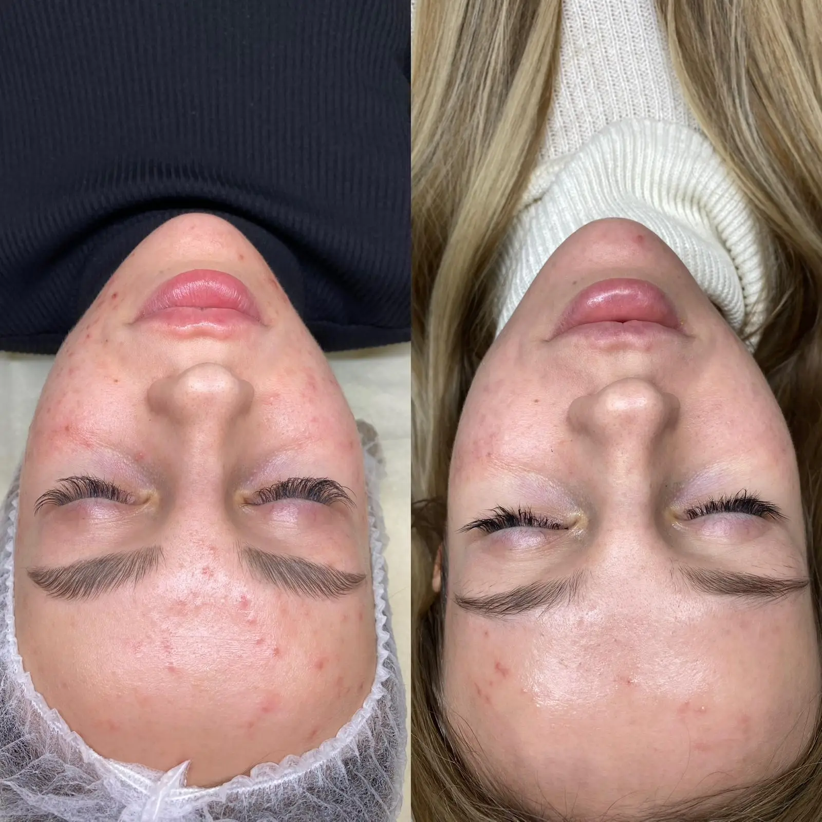 Efekty zabiegu peelingiem chemicznym - Studio AZYL