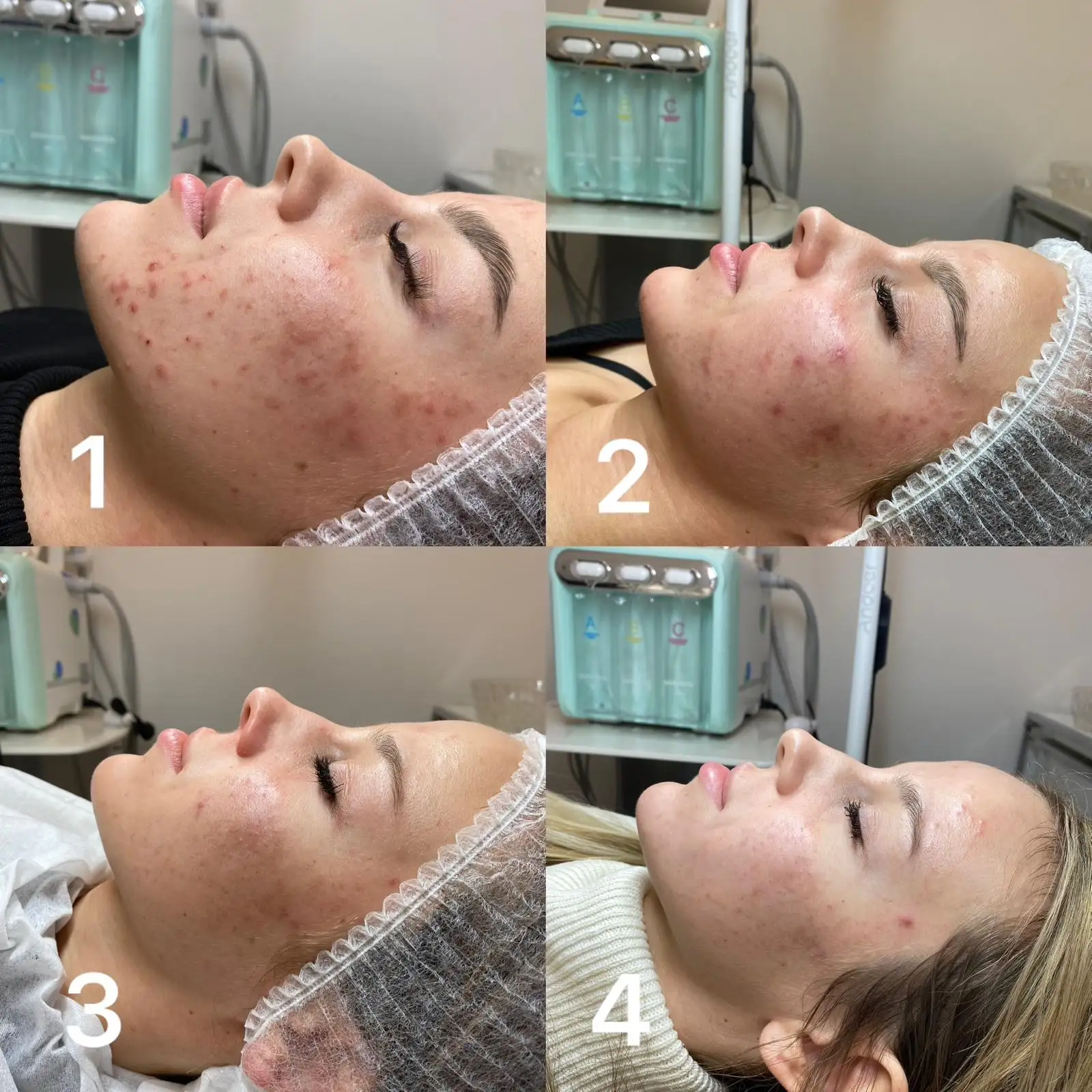 Peeling chemiczny efekty - Studio AZYL Nowy Targ
