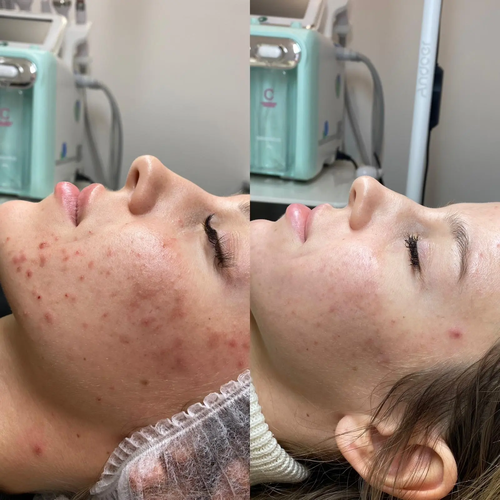 Peeling chemiczny Nowy Targ efekty długoterminowe
